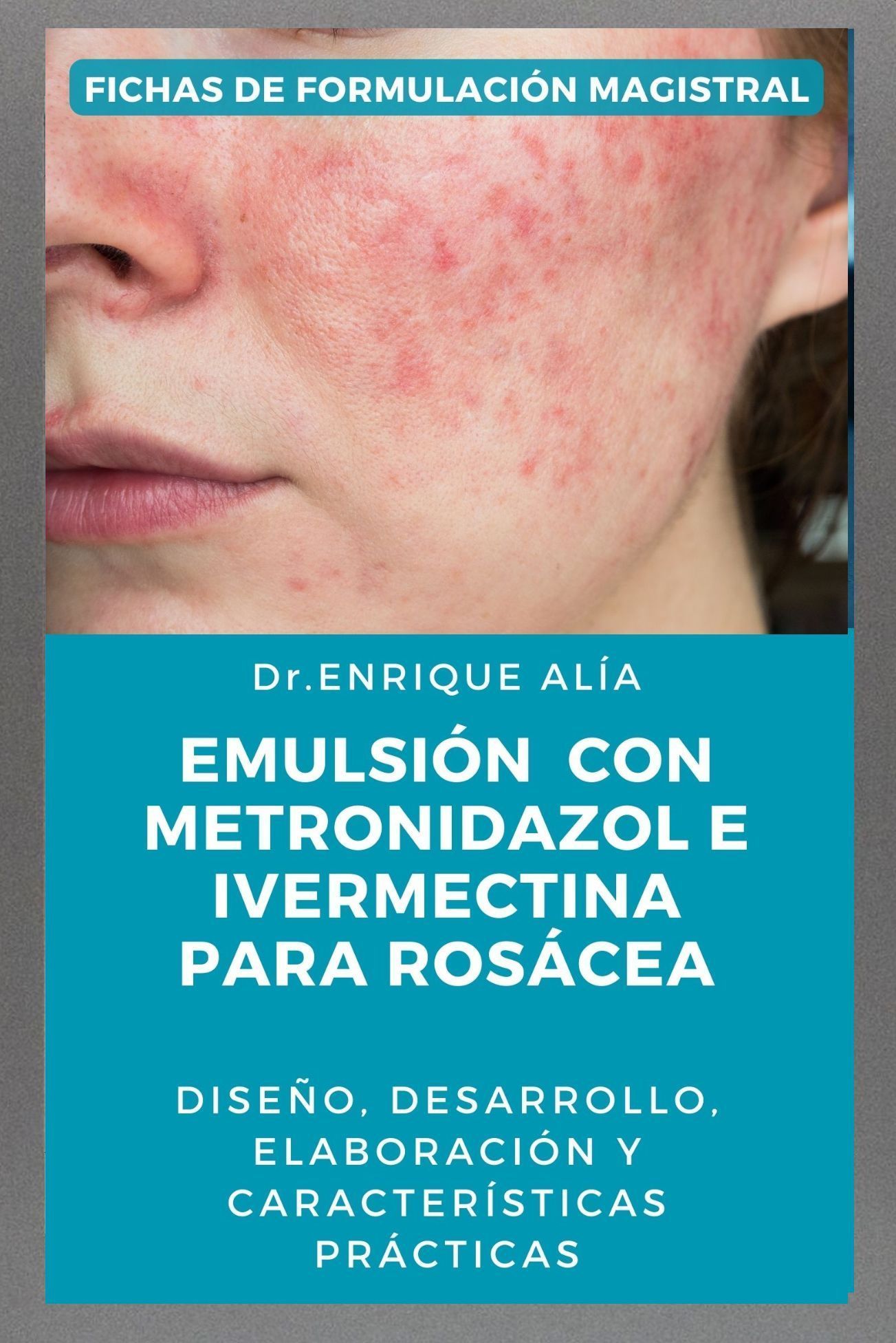 Emulsión con metronidazol e ivermectina para rosácea