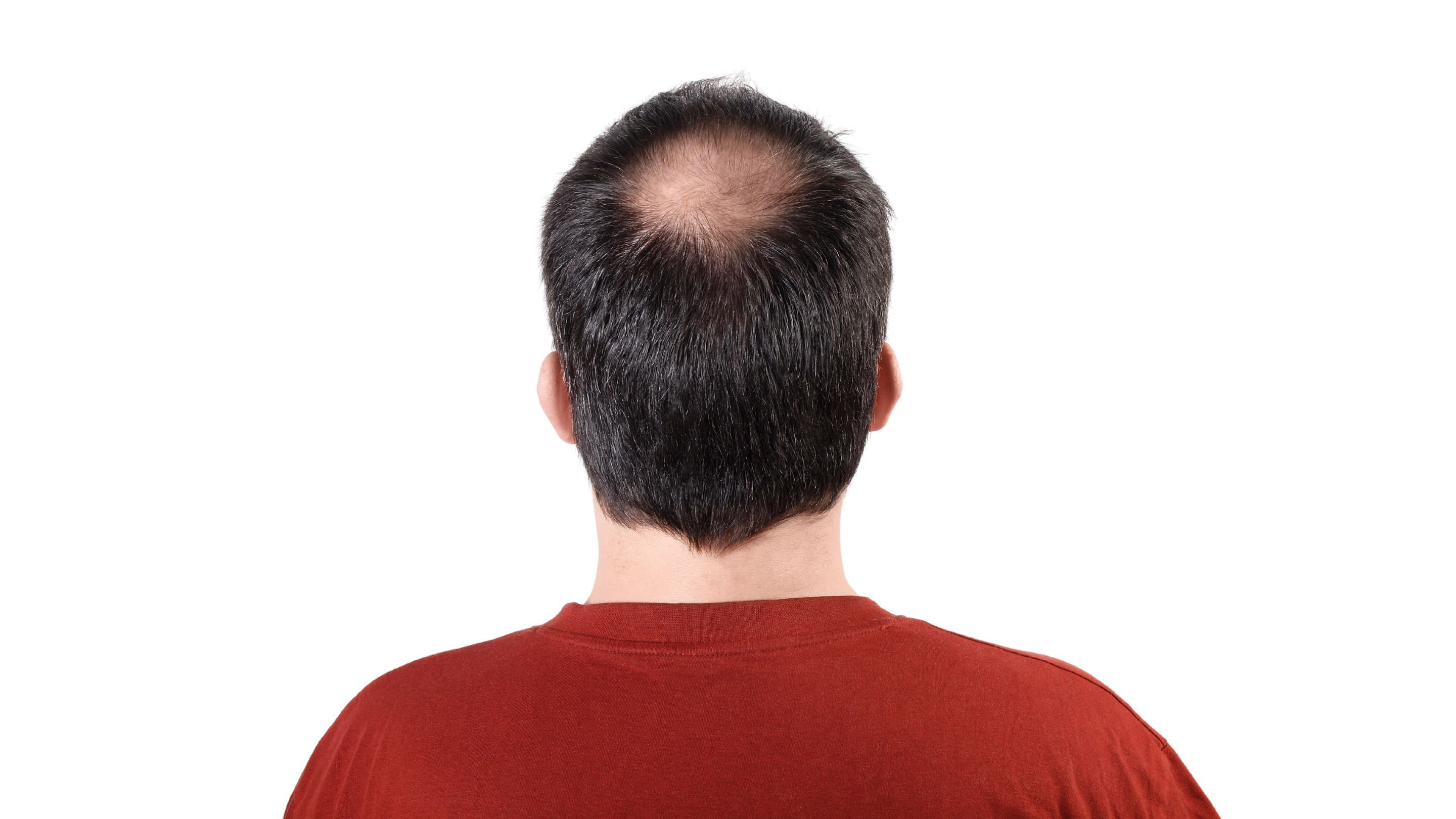 Solución minoxidil y finasteride sin propilenglicol