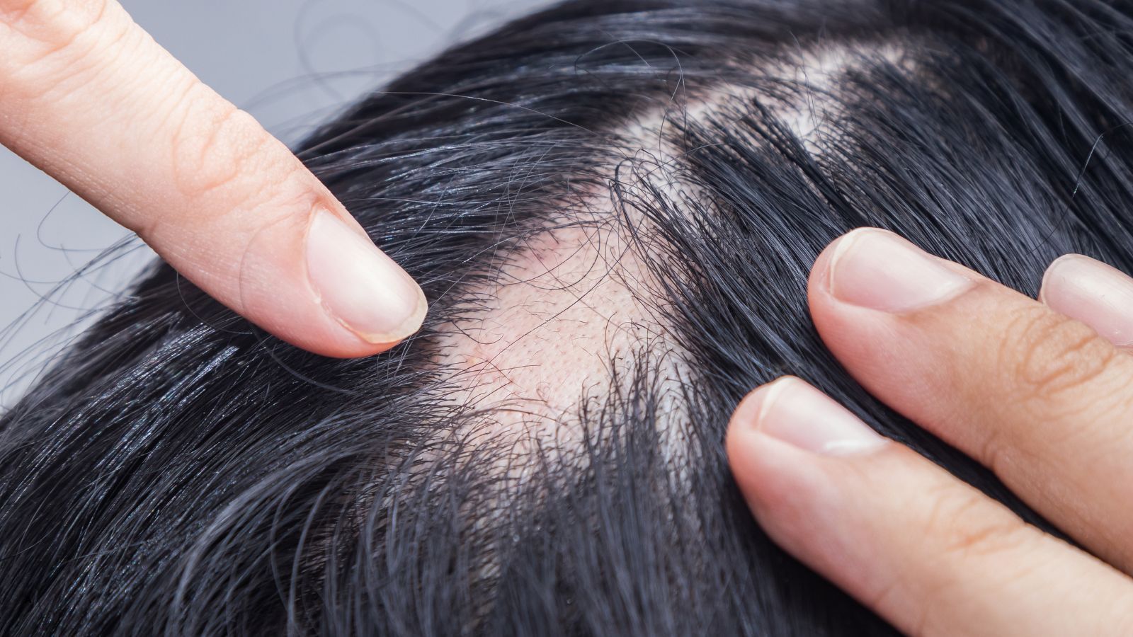 Elaboración de una Solución para Alopecia Areata