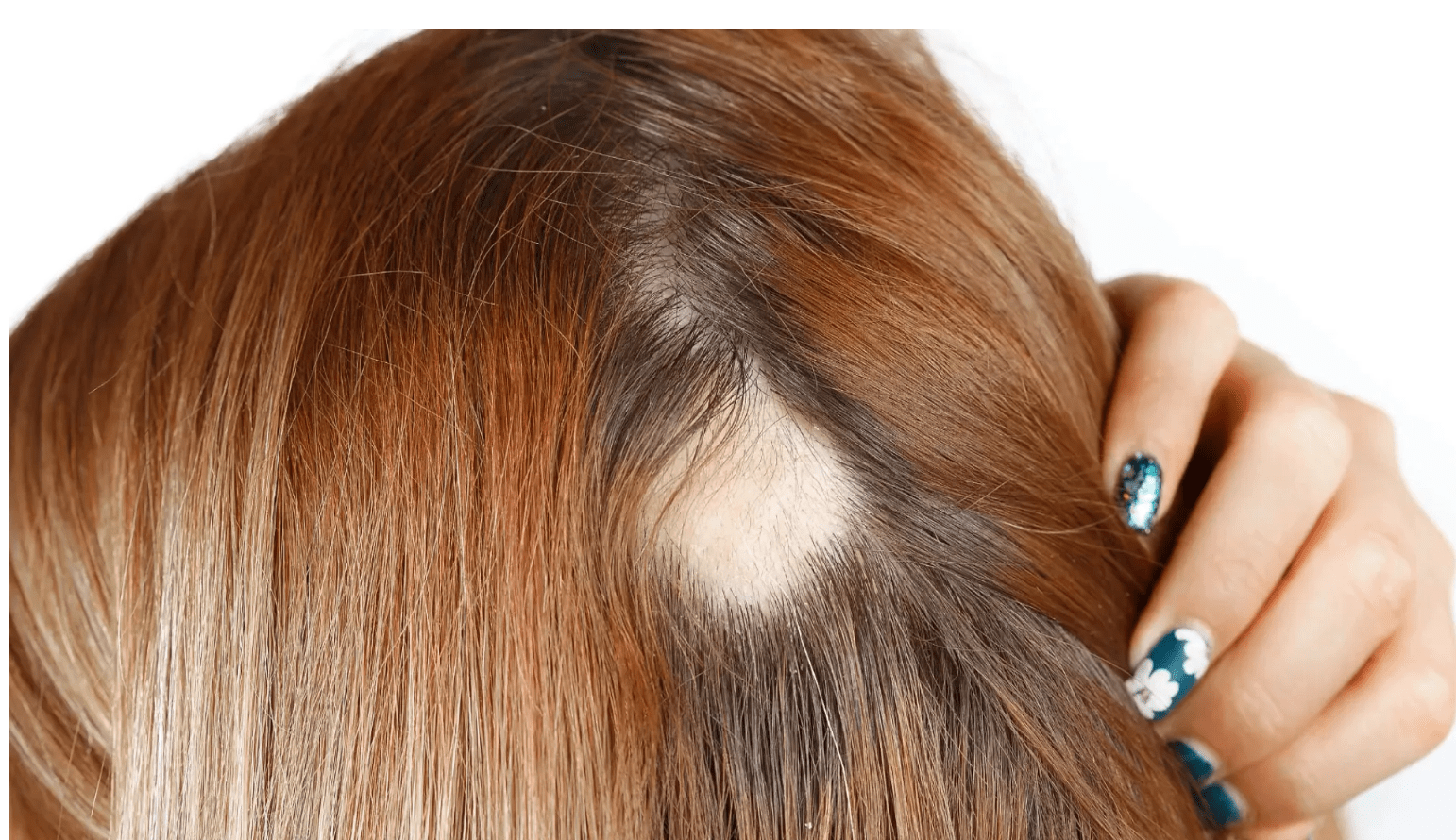 Solución para la Alopecia Areata: Minoxidil y Ácido Retinoico sin Propilenglicol