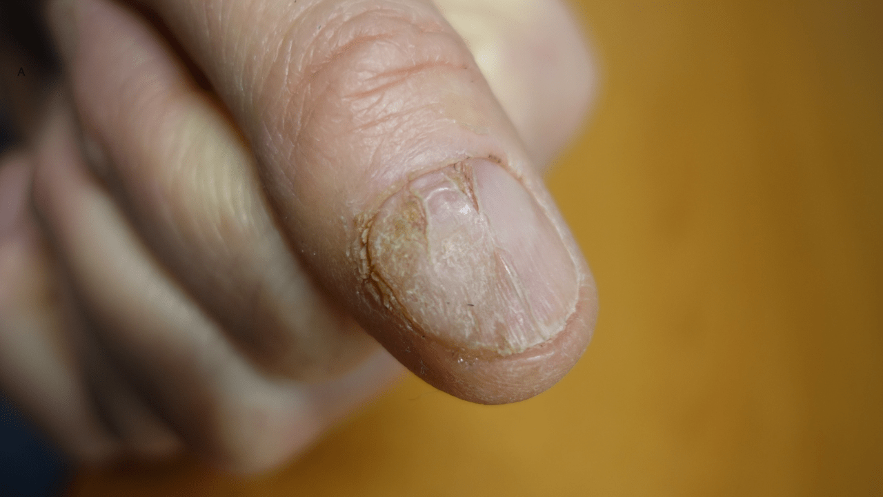 psoriasis ungueal