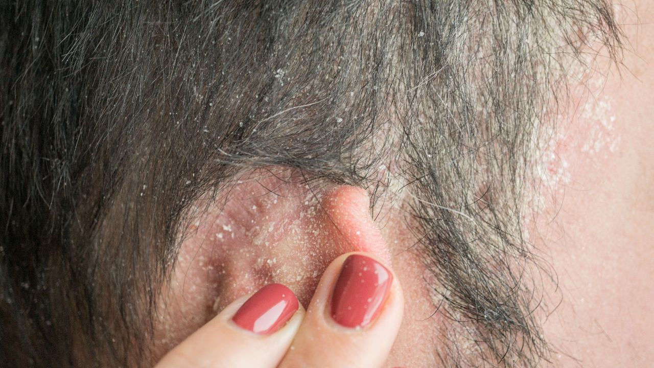 Cómo elaborar una emulsión fluida tipo loción para la psoriasis del cuero cabelludo