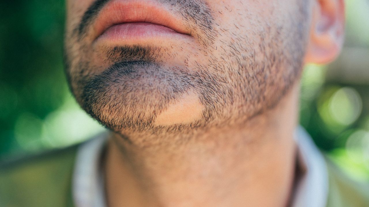 Formulación de un Gel con Minoxidil 5% y Clobetasol 0,05% para Alopecia Areata en Barba