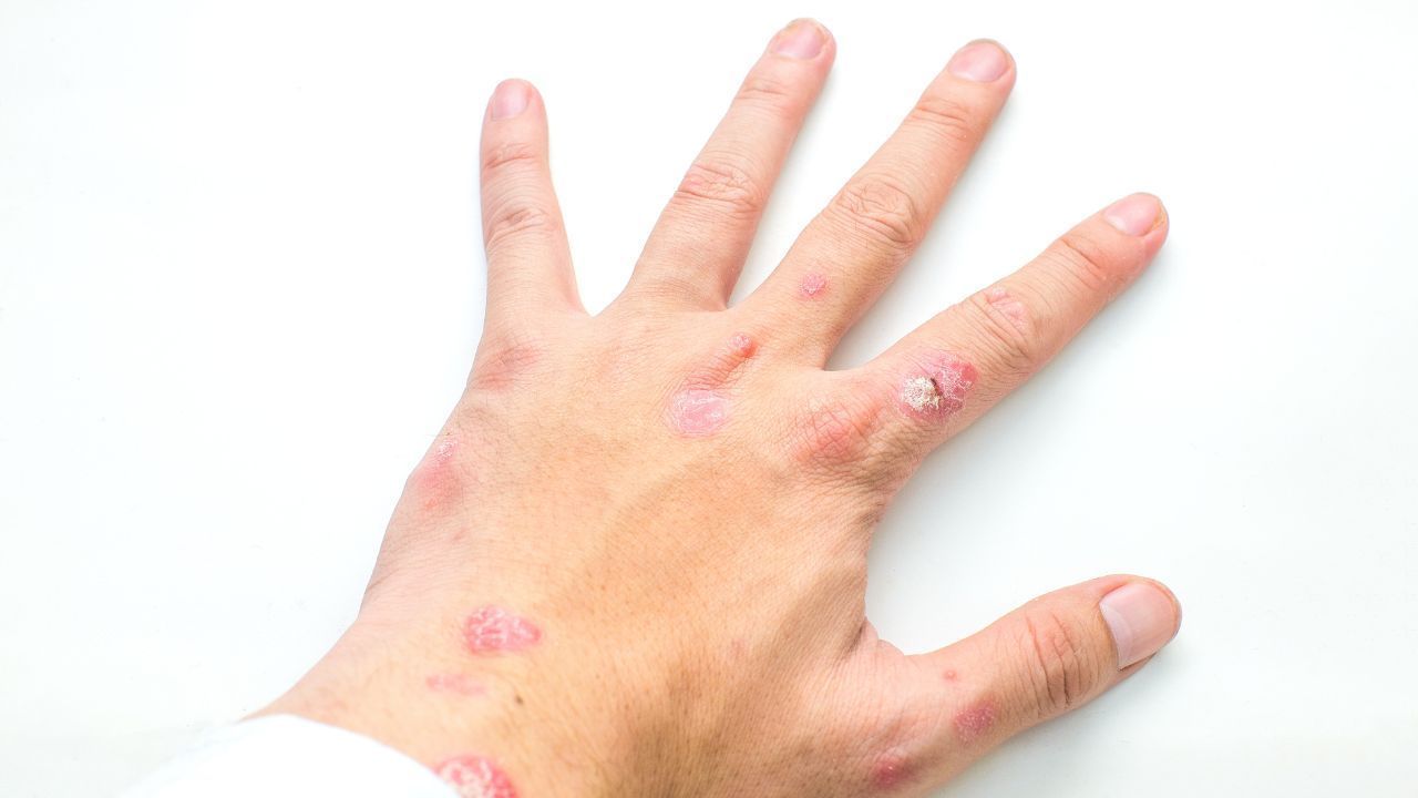 Crema para Psoriasis: cómo formular ácido salicílico y triamcinolona en base Lanette
