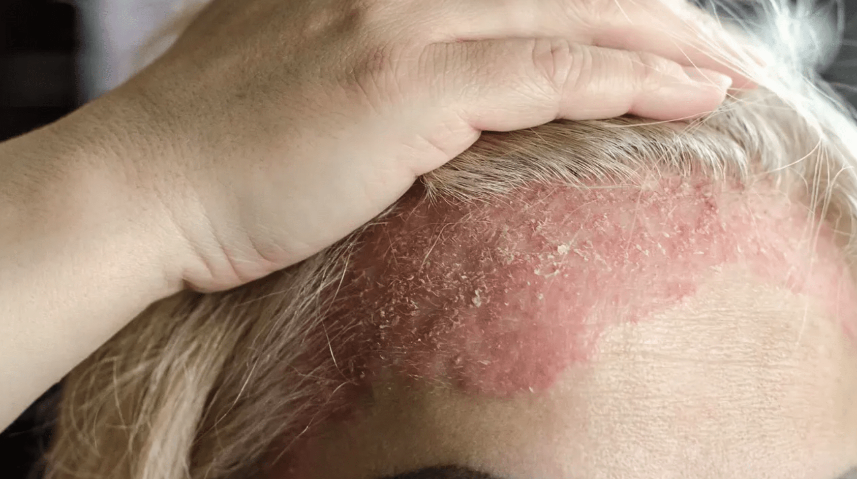 Psoriasis cuero cabelludo: cómo formular un gel de fluocinolona acetónido